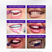 Hismile V34 Teeth Whitening Strips